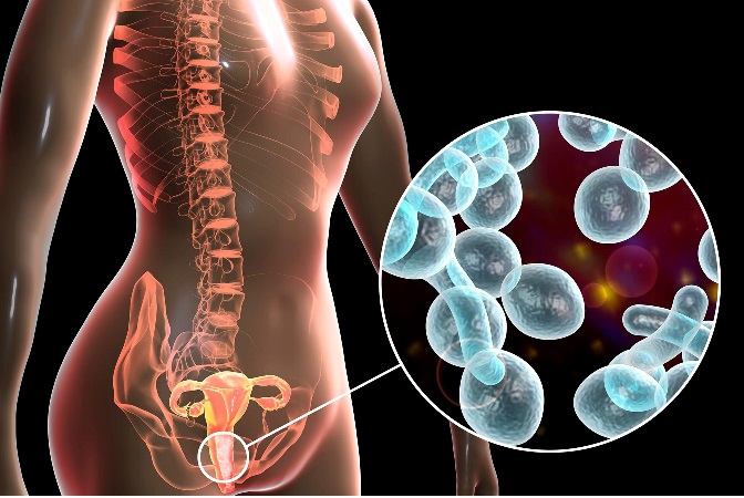 CANDIDIASIS INFECCION VAGINAL HONGOS GENITALES TRATAMIENTO ELIMINAR