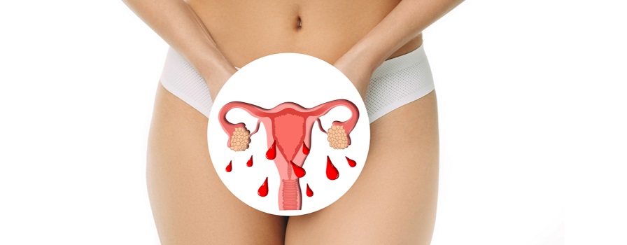 CANDIDIASIS VAGINAL MENSTRUACIÓN CAMBIOS HORMONALES COMEZÓN VAGINAL
