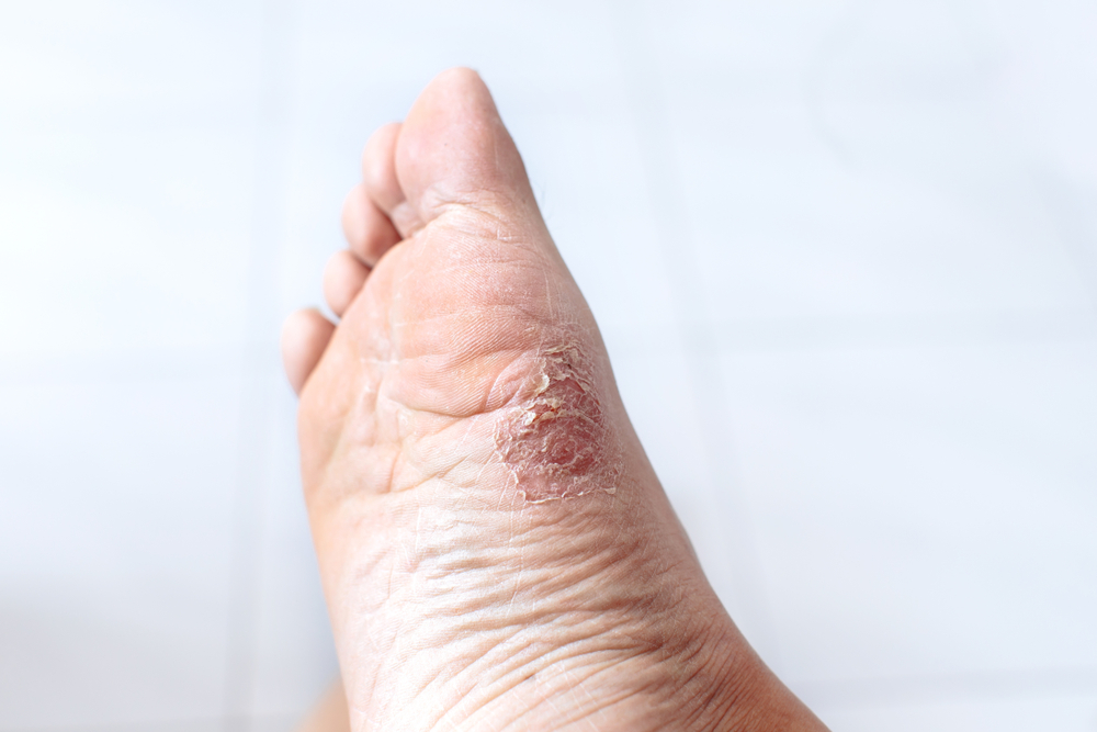 how to prevent athletes foot with athelte's foot images